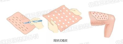 傷口恢復為啥要植皮？