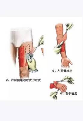 傷口植皮，你真的需要嗎？