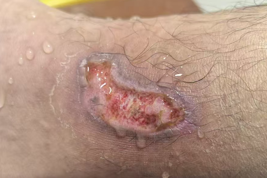 低溫燙傷：難愈合的核心原因 ——ATATA-愛氏抑菌液低溫燙傷案例分享【二】