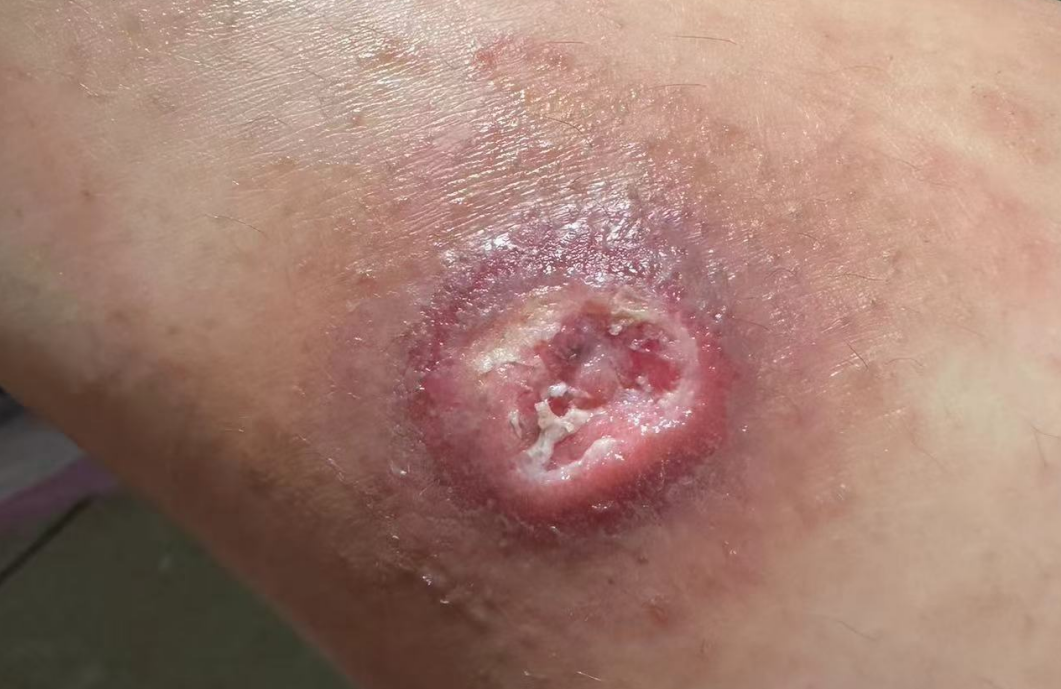 低溫燙傷：溫柔的殺手 ——ATATA-愛氏抑菌液低溫燙傷案例分享【一】