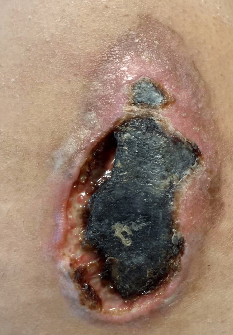 低溫燙傷：愈合的關鍵措施 ——ATATA-愛氏抑菌液低溫燙傷案例分享【三】