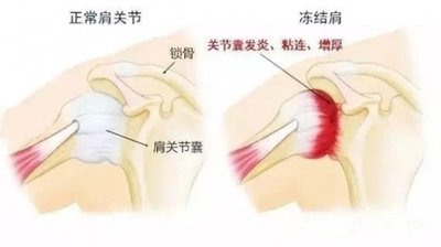 一文讀懂肩周炎：發(fā)病、癥狀與防治全攻略