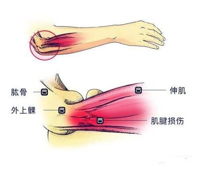 冰敷還是熱敷？網球肘急性期與慢性期家庭處理指南