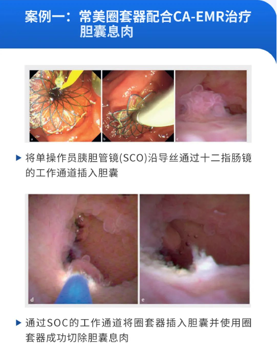 膽胰診療新突破！常美協(xié)助剿滅病變