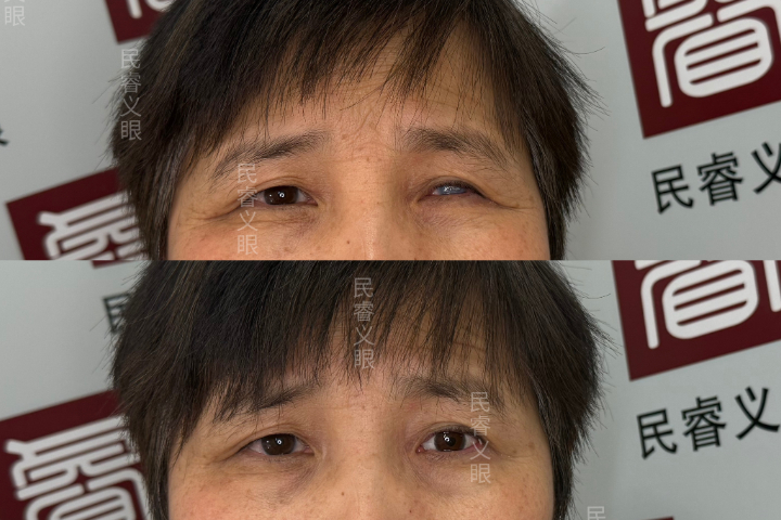 上海先天性小眼球低价定制义眼没有分泌物,低价定制义眼