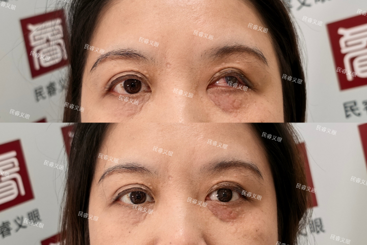 上海摘除低价定制义眼材料,低价定制义眼