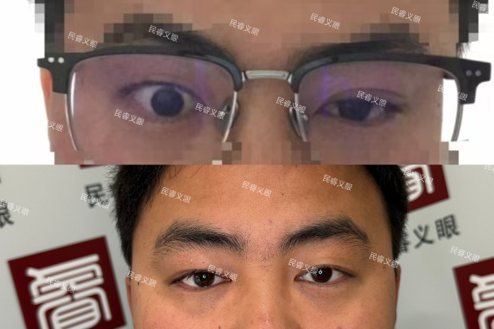 上海仿生低價(jià)定制義眼在哪里 上海崇睿醫(yī)療器械科技供應(yīng)