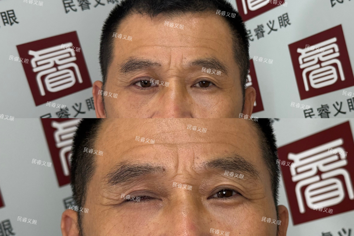 新疆安装低价定制义眼需要多久,低价定制义眼