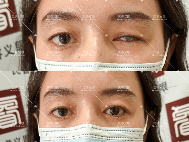 上海樹脂低價定制義眼多少錢 上海崇睿醫(yī)療器械科技供應