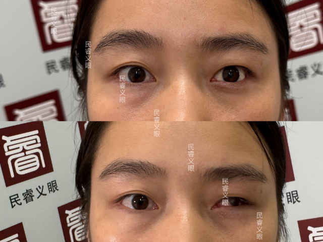 上海超薄低價定制義眼清洗 上海崇睿醫(yī)療器械科技供應