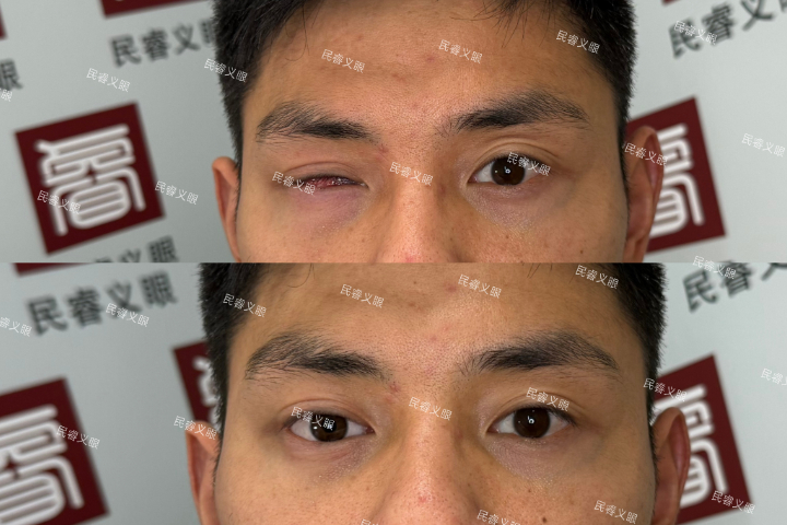 上海高分子低价定制义眼,低价定制义眼