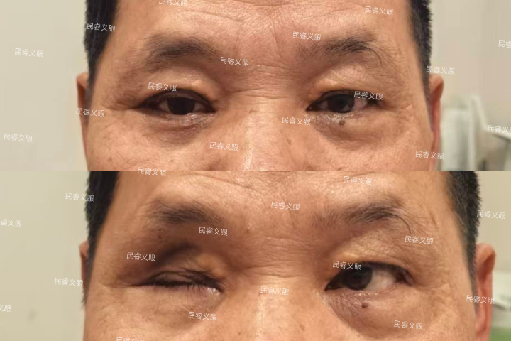 陕西低价定制义眼需要多久