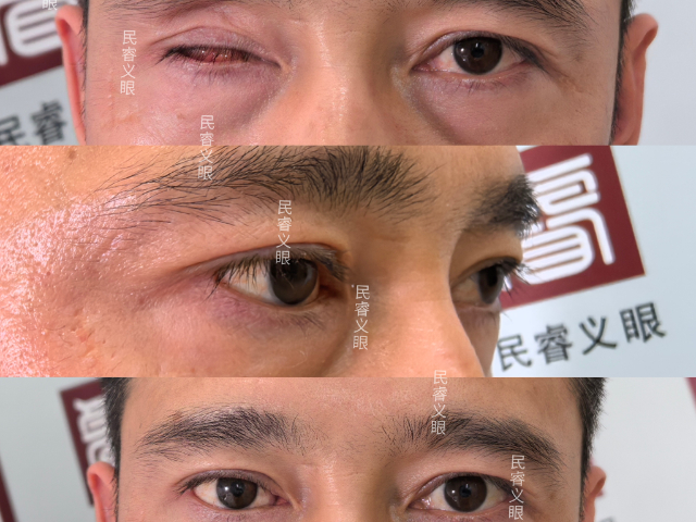 江西超轻眼球保留义眼多少钱