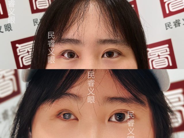 安徽眼摘假眼哪家好,假眼