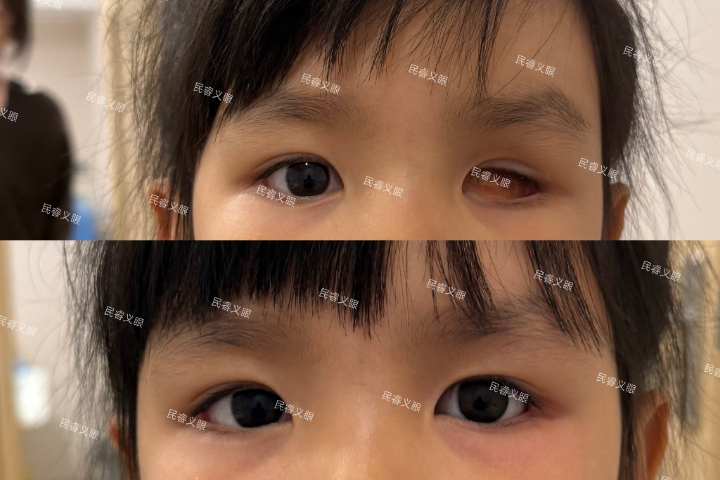 山西摘除假眼价格,假眼