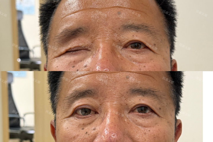 超轻假眼低价保养