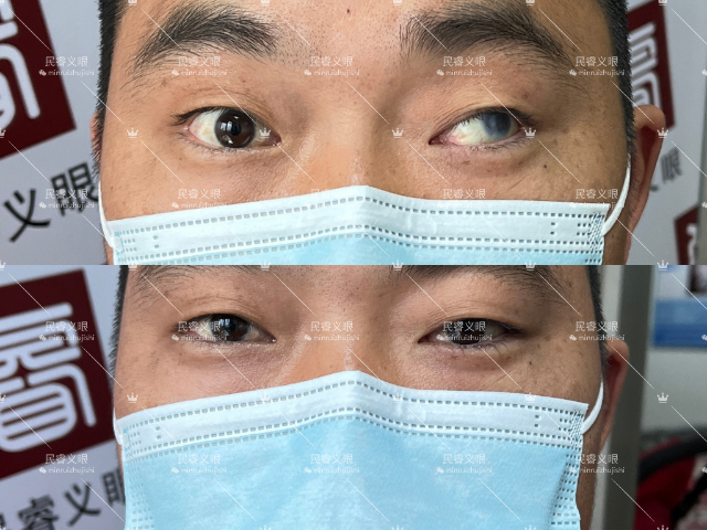 上海超薄低价定制义眼哪家好,低价定制义眼