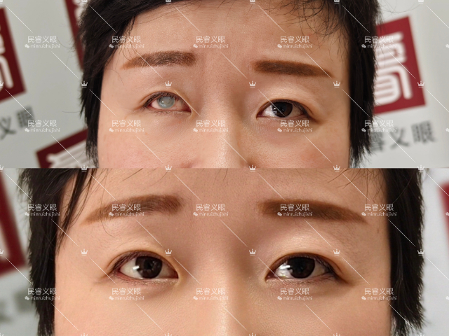 上海人工低价定制义眼清洗,低价定制义眼