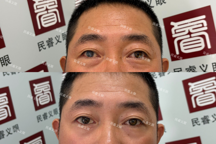 黑龙江仿生眼球保留义眼