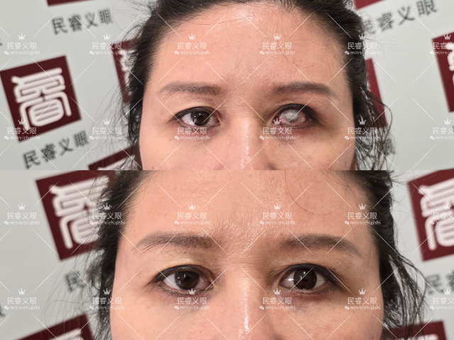 广东树脂低价定制义眼,低价定制义眼