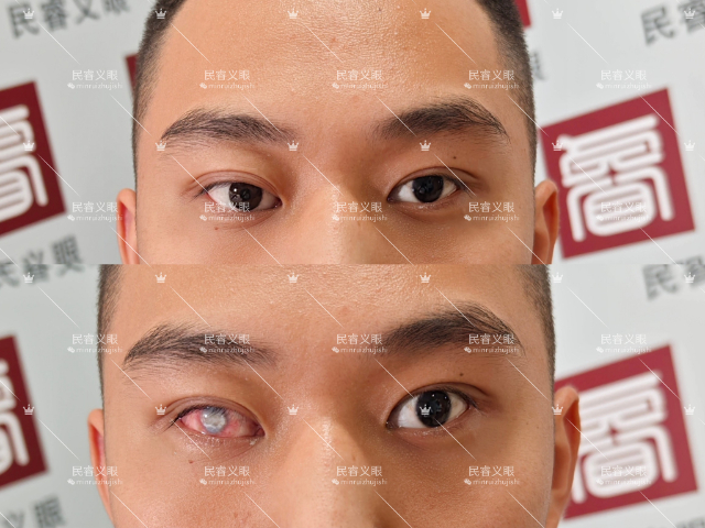 上海单眼低价定制义眼清洗,低价定制义眼