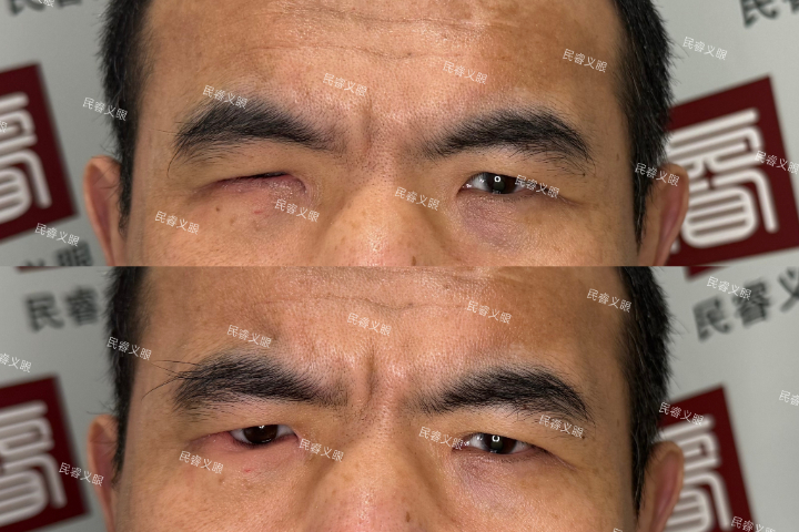 云南超薄低价定制义眼在哪里,低价定制义眼