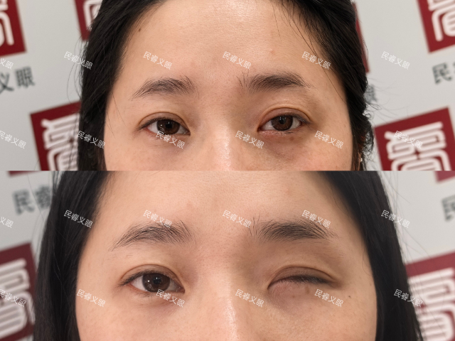 山西仿生低价定制义眼在哪里,低价定制义眼