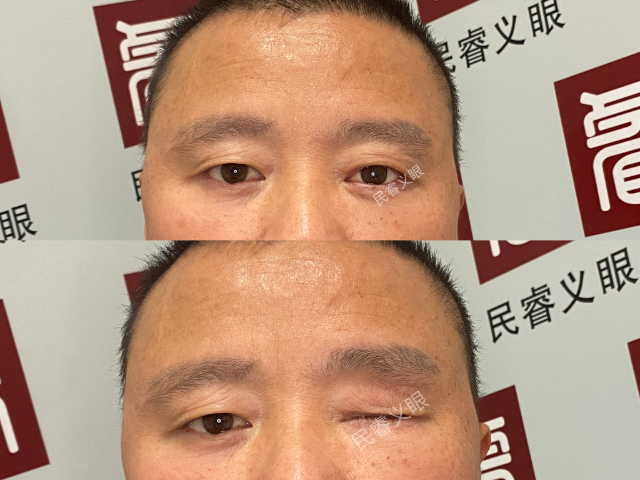 辽宁单眼眼球保留义眼