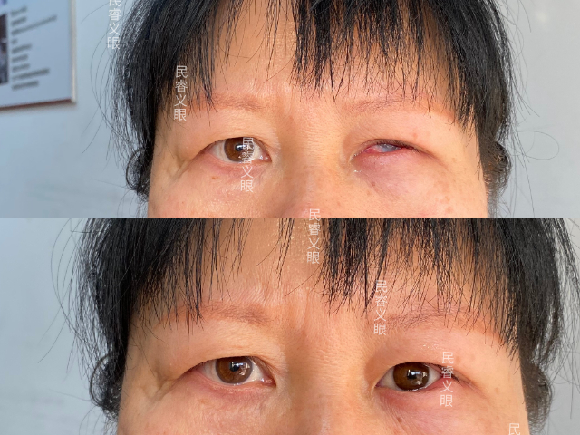 广东树脂低价定制义眼,低价定制义眼