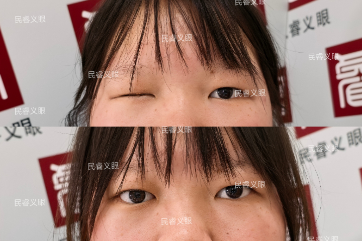 吉林安装假眼哪家好