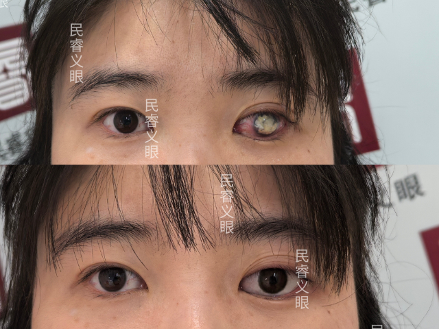 山西摘除假眼价格,假眼