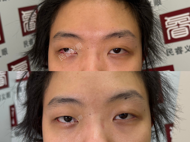 江西民睿眼球保留义眼护理