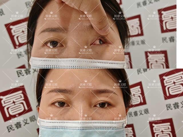 上海摘除低價定制義眼 上海崇睿醫(yī)療器械科技供應