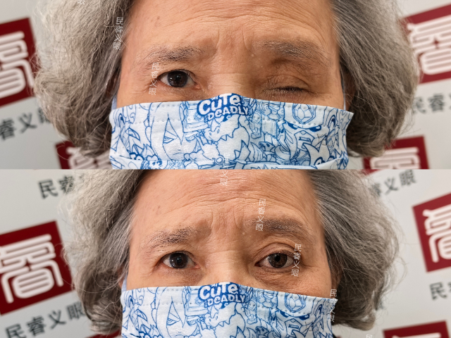 四川眼摘低价定制义眼舒适,低价定制义眼