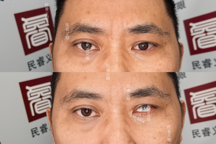 河南单眼假眼哪家好