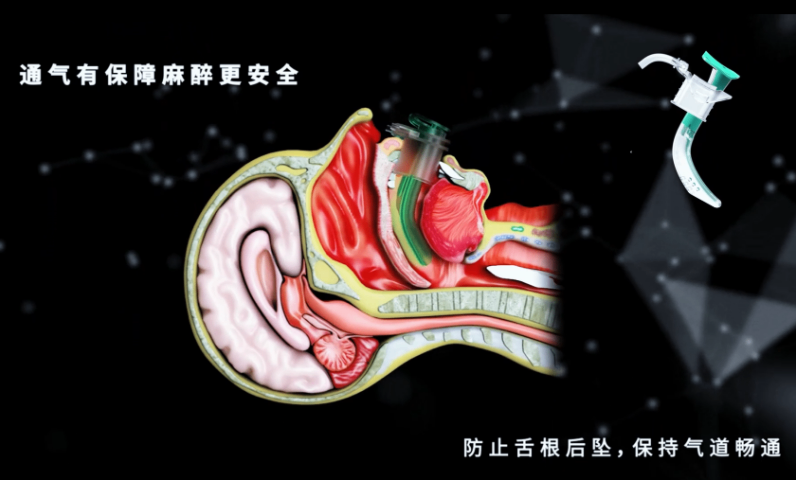 北京无痛口咽通气道耗材,口咽通气道