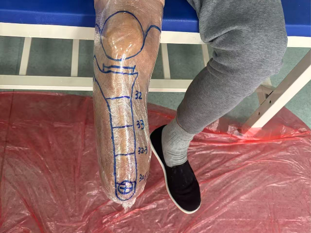 邵阳假肢技术指导,假肢